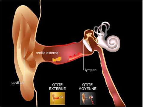 Otite