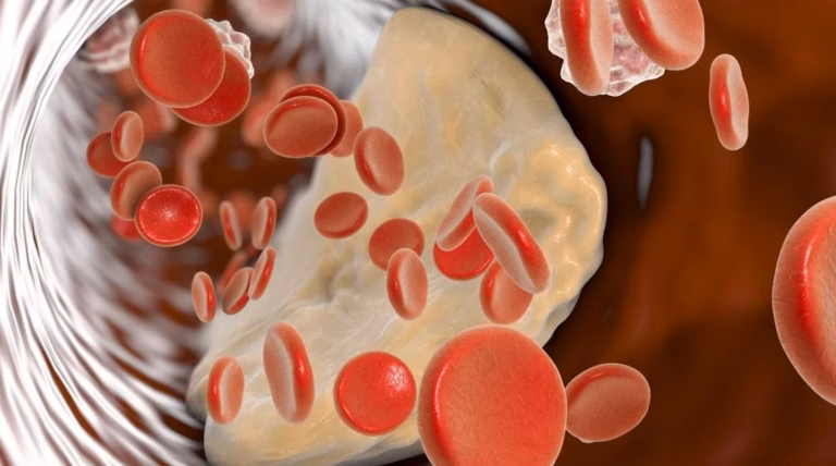 Albumine élevée dans le sang : quelles causes