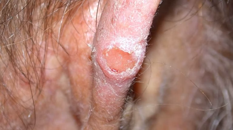 Cas insolite : elle éternue et des vers s&rsquo;échappent de son nez, une infection hors du commun révélée